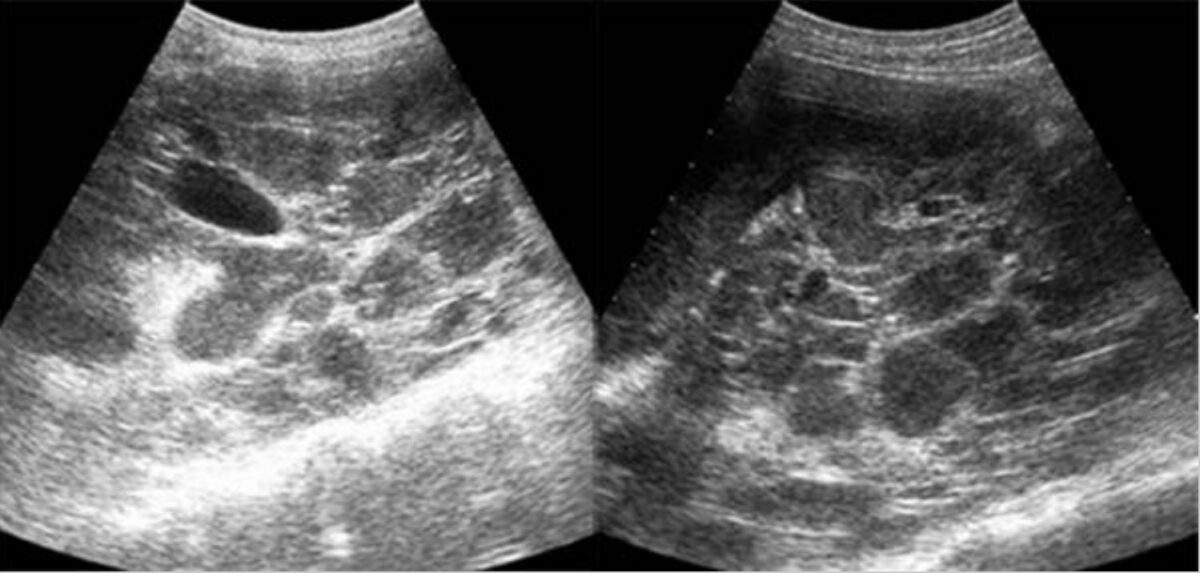 Ultrasound of autosomal dominant polycystic kidney disease