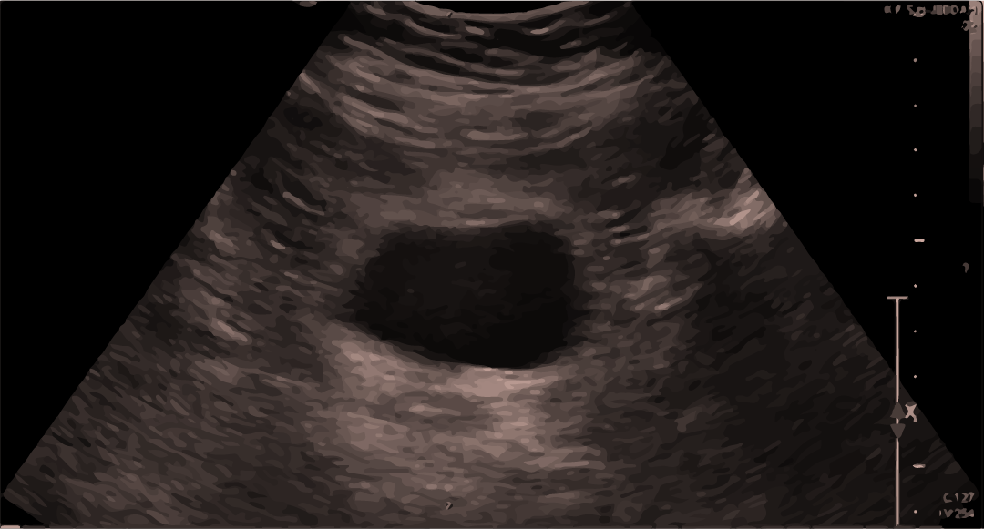 Ultrasound of the bladder