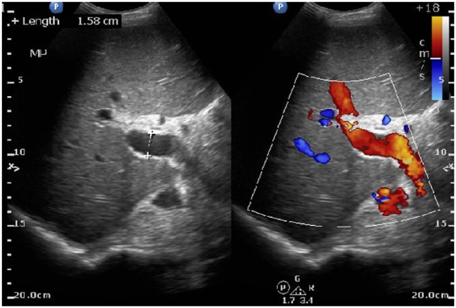 Ultrasound of the liver identifies a large portal vein consistent with portal hypertension