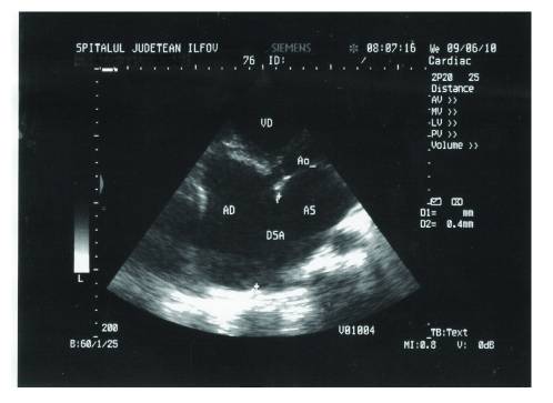 Ultrasound of woman with atrial septal defect