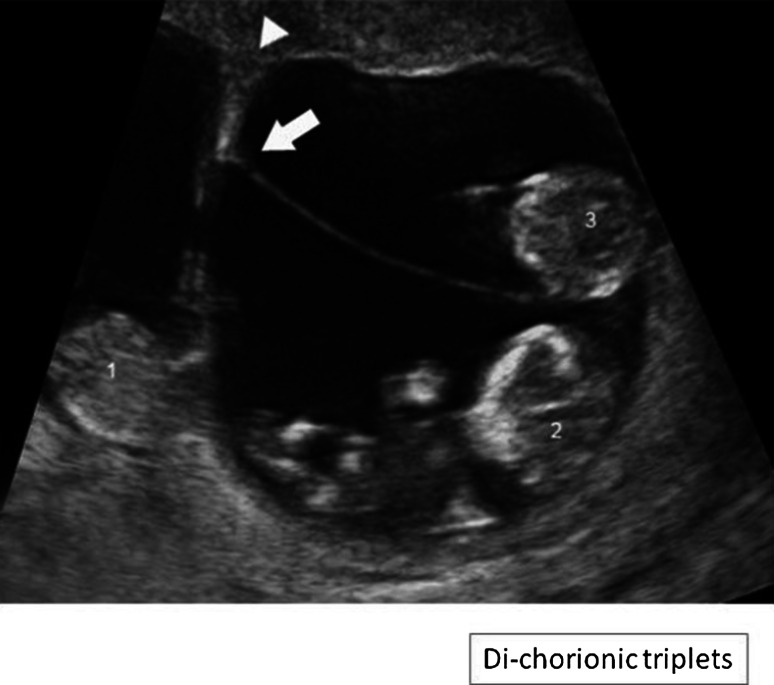 Ultrasound picture of a dichorionic-triamniotic triplet pregnancy