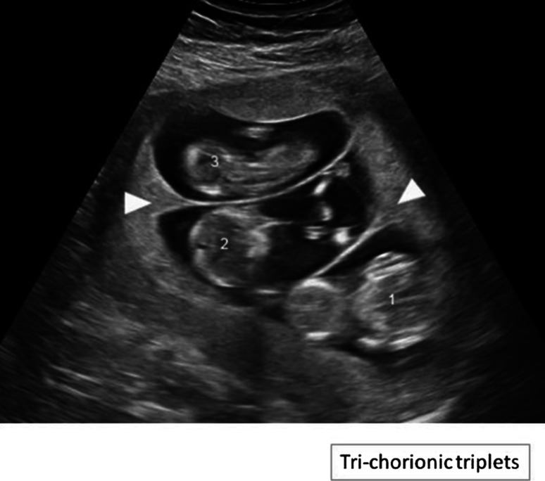 Ultrasound picture of trichorionic-triamniotic triplets