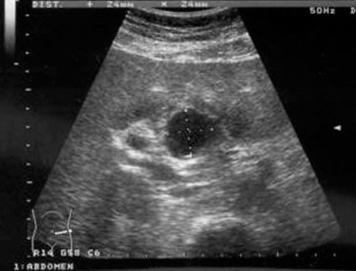 Ultrasound scan of aneursyma