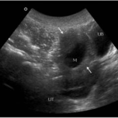 Ultrasound showcasing an ovarian cyst