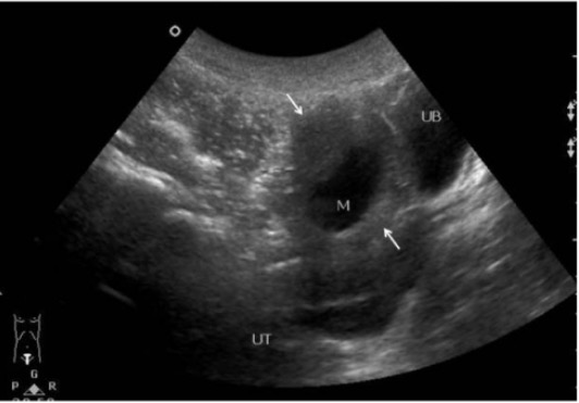 Ultrasound showing an ovarian cyst