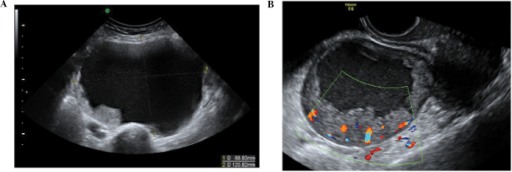 Ultrasounds of malignant ovarian epithelial tumors