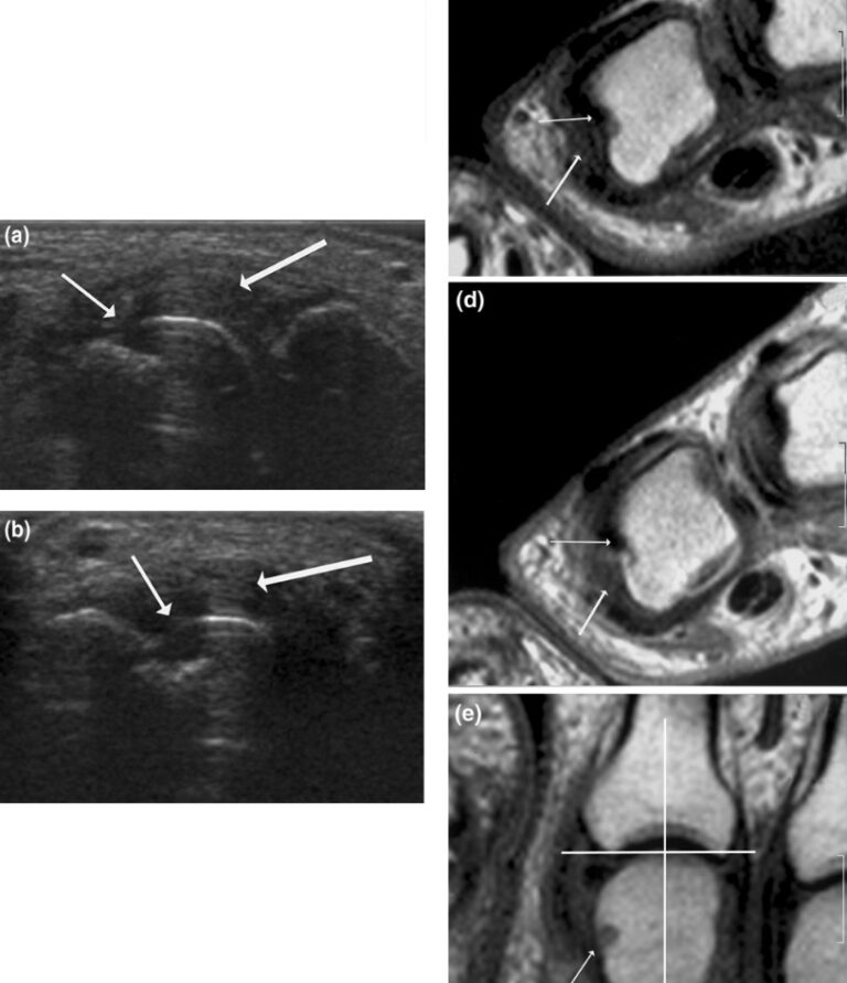 Rheumatoid Arthritis Concise Medical Knowledge