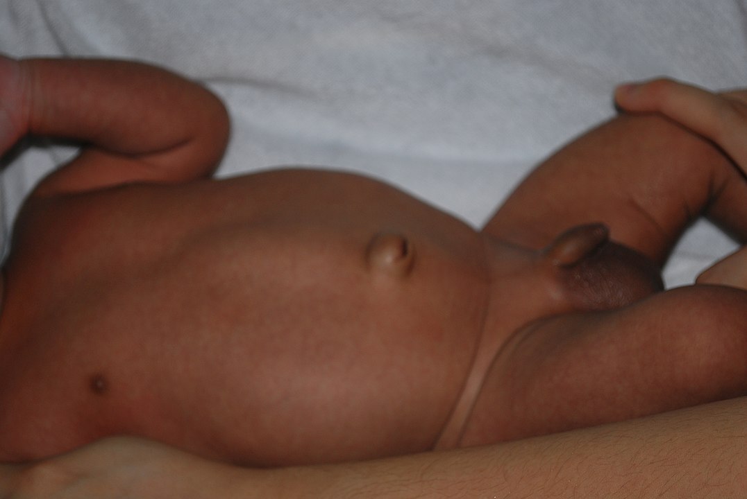 Umbilical hernia in a child