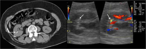 Unenhanced ct confirms the presence of a renal stone