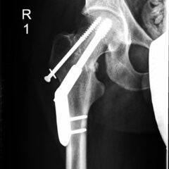 Unspecified displaced fracture of the right femur with surgical repair