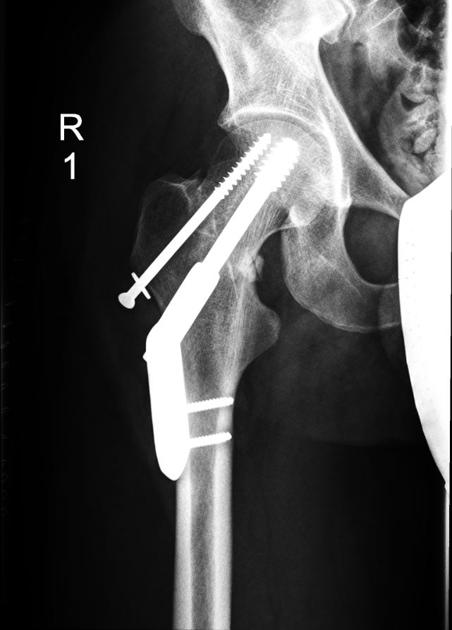 Fractura desplazada no especificada del fémur derecho con reparación quirúrgica