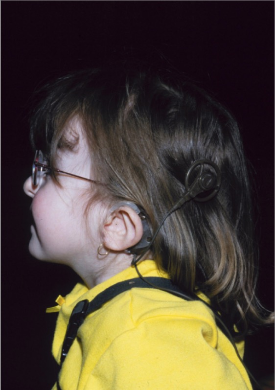Unusually shaped ears charge syndrome