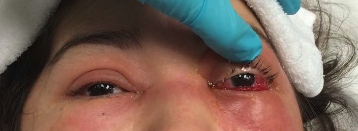 Upper and lower eyelid edema and erythema and conjunctival chemosis