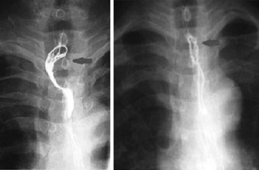 radiografía de cáncer de esófago