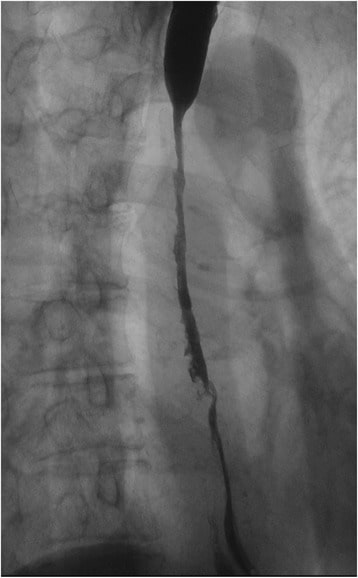 Gastroesophageal Reflux Disease Gerd Concise Medical Knowledge