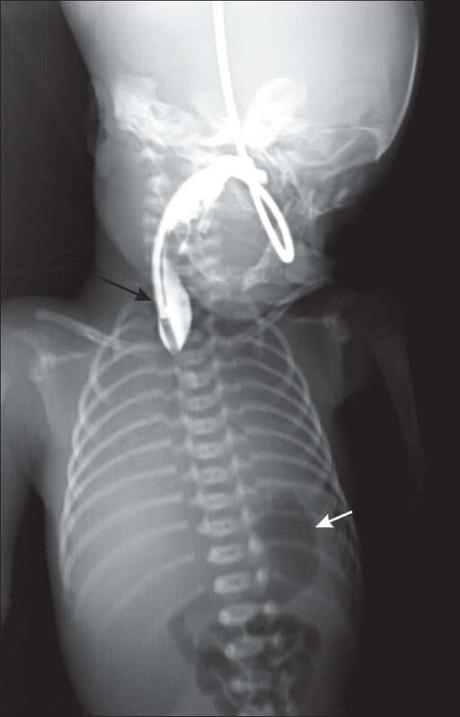 Upper neck pouch sign in the antenatal diagnosis of esophageal atresia