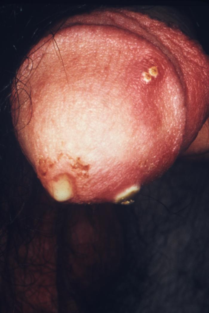 Urethritis due to gonorrhea