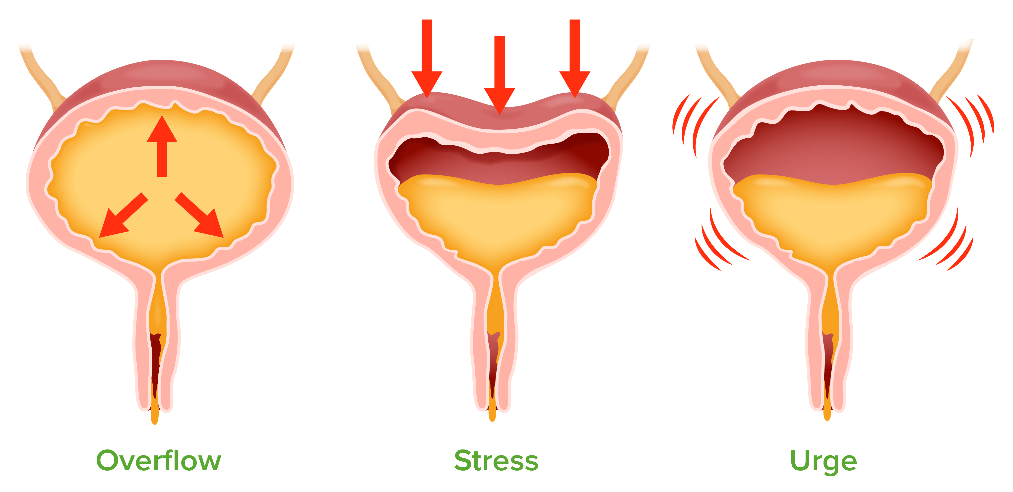  Common Causes Of Difficulties With Continence Free Essays On List 