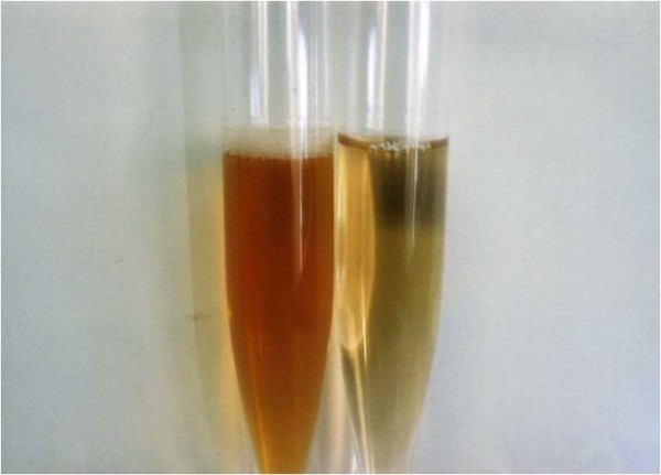 Paroxysmal Nocturnal Hemoglobinuria Urine