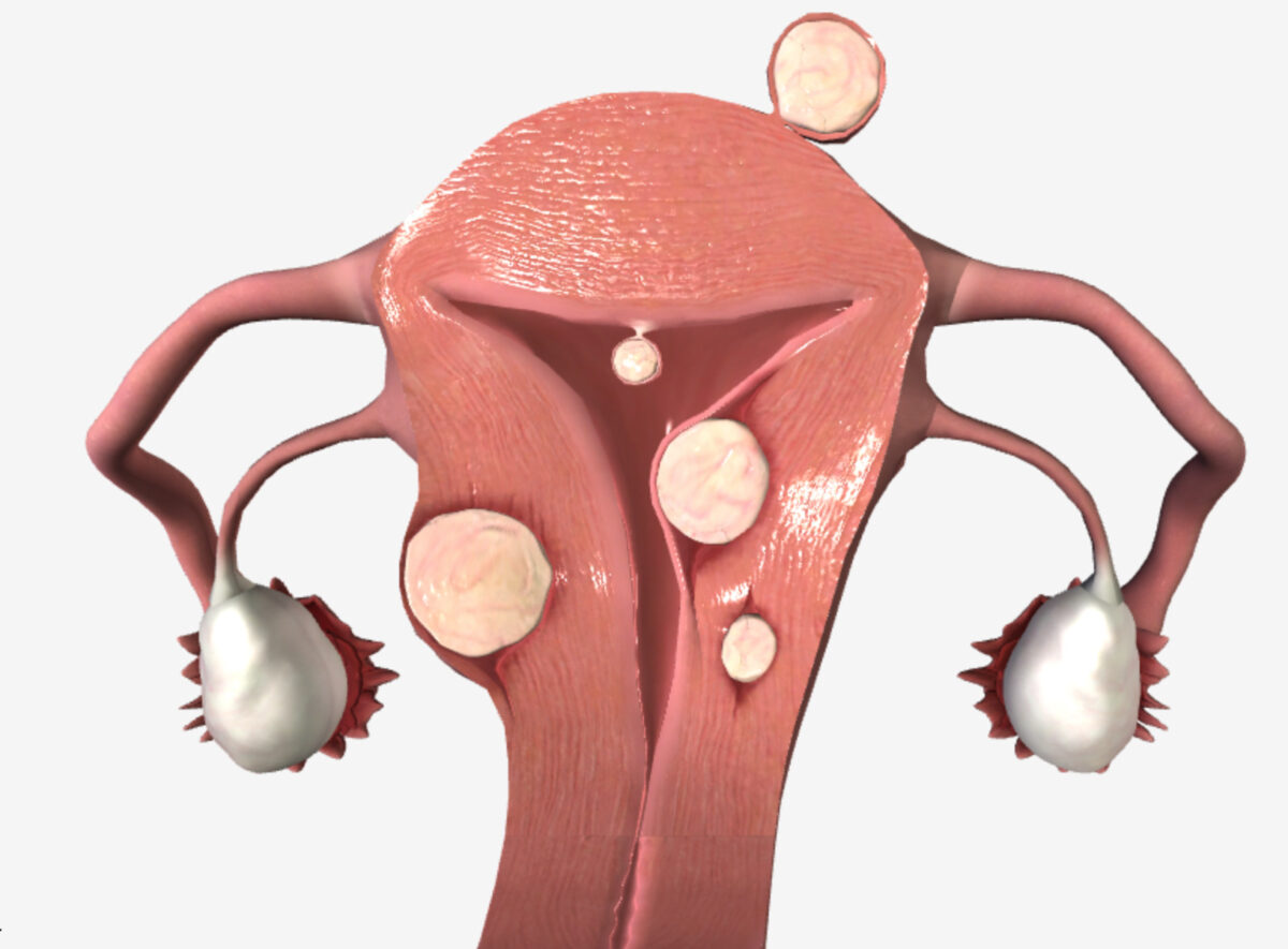 Uterine fibroids