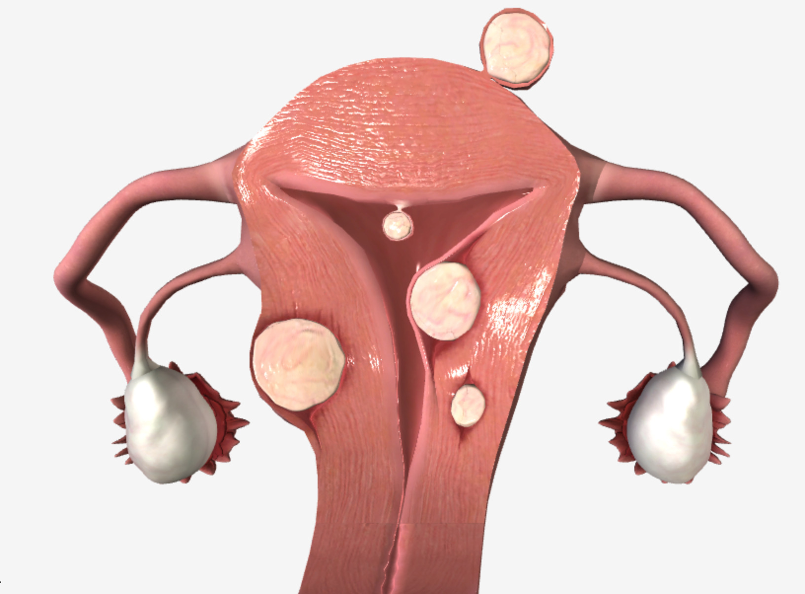 Abnormal Uterine Bleeding  Concise Medical Knowledge