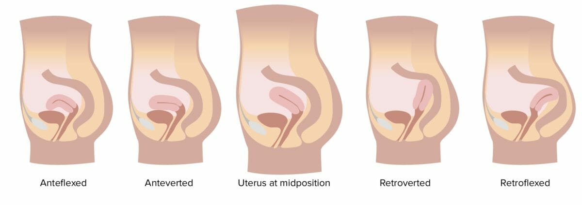 Uterine orientations