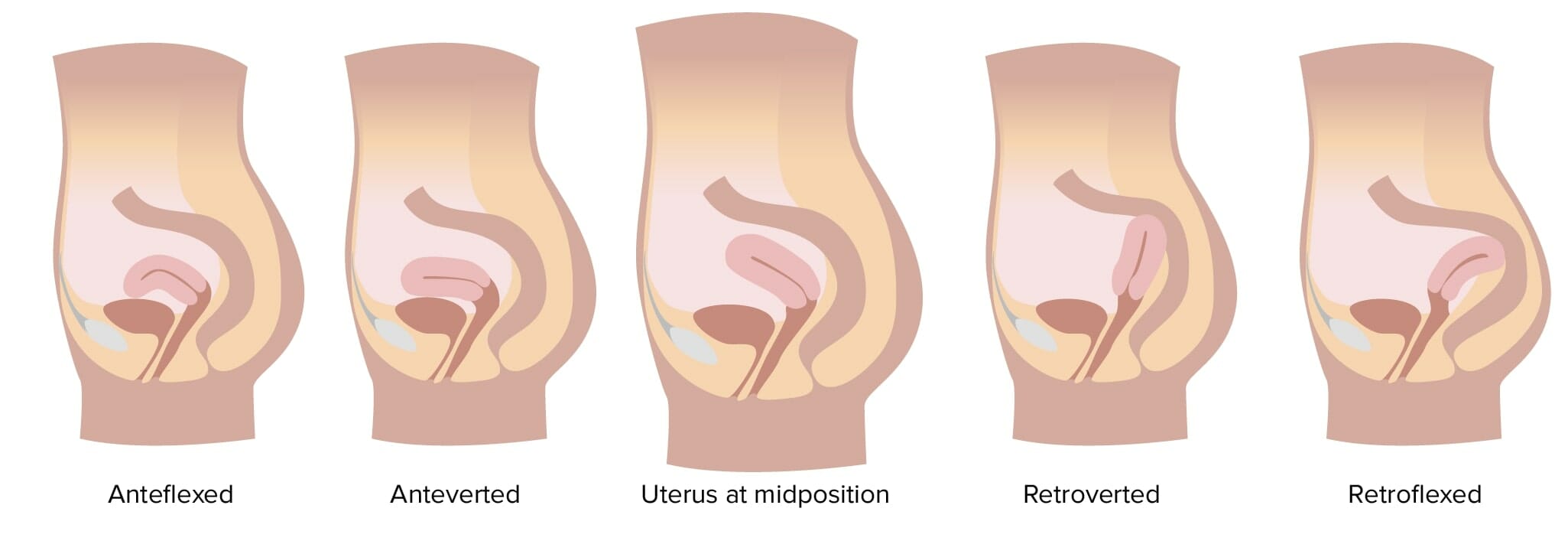 endometrium hipertónia