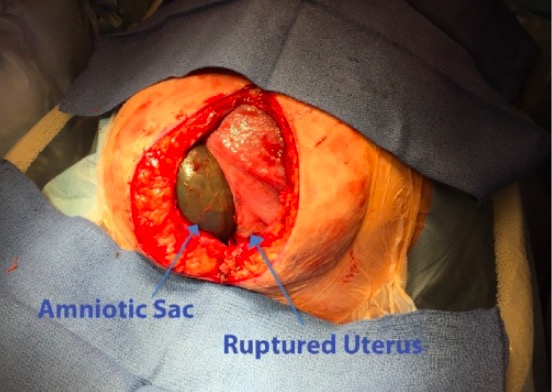 Uterine rupture photograph