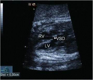 Vsd detected by fetal echocardiography