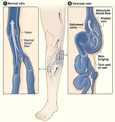 Chronic Venous Insufficiency