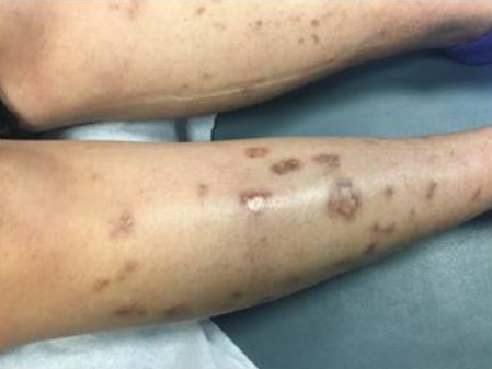 Vasculitic skin changes and ulceration noted in a patient with sjögren syndrome