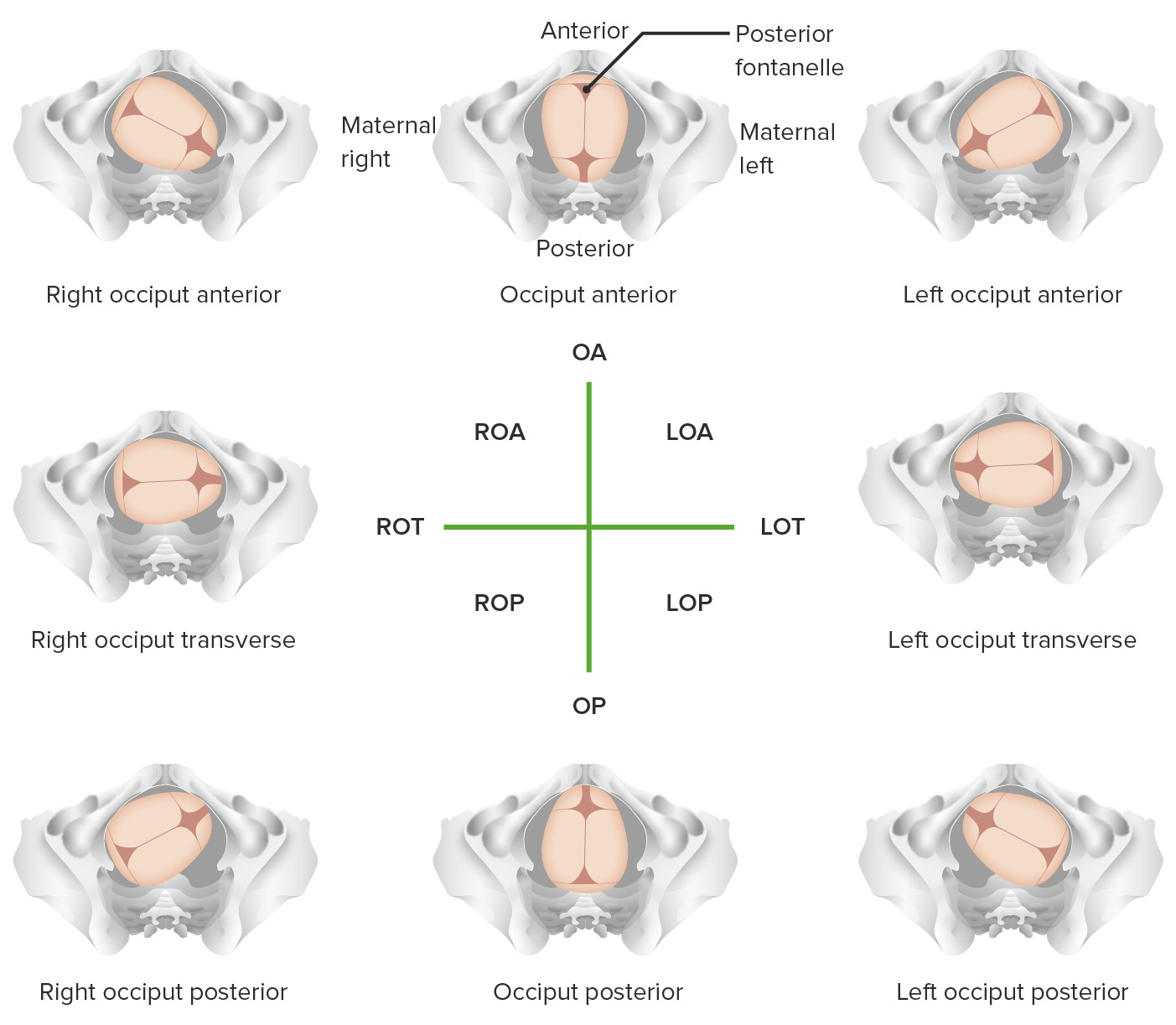 Direct Occiput Anterior Position