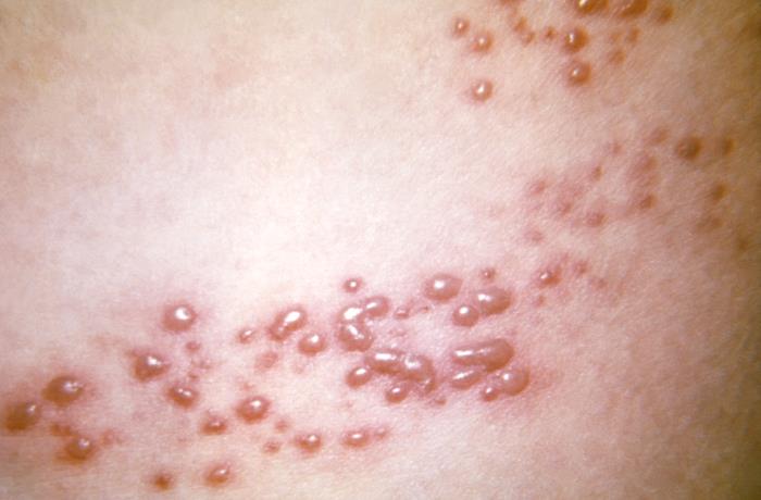 Vesicular rash of shingles herpes zoster