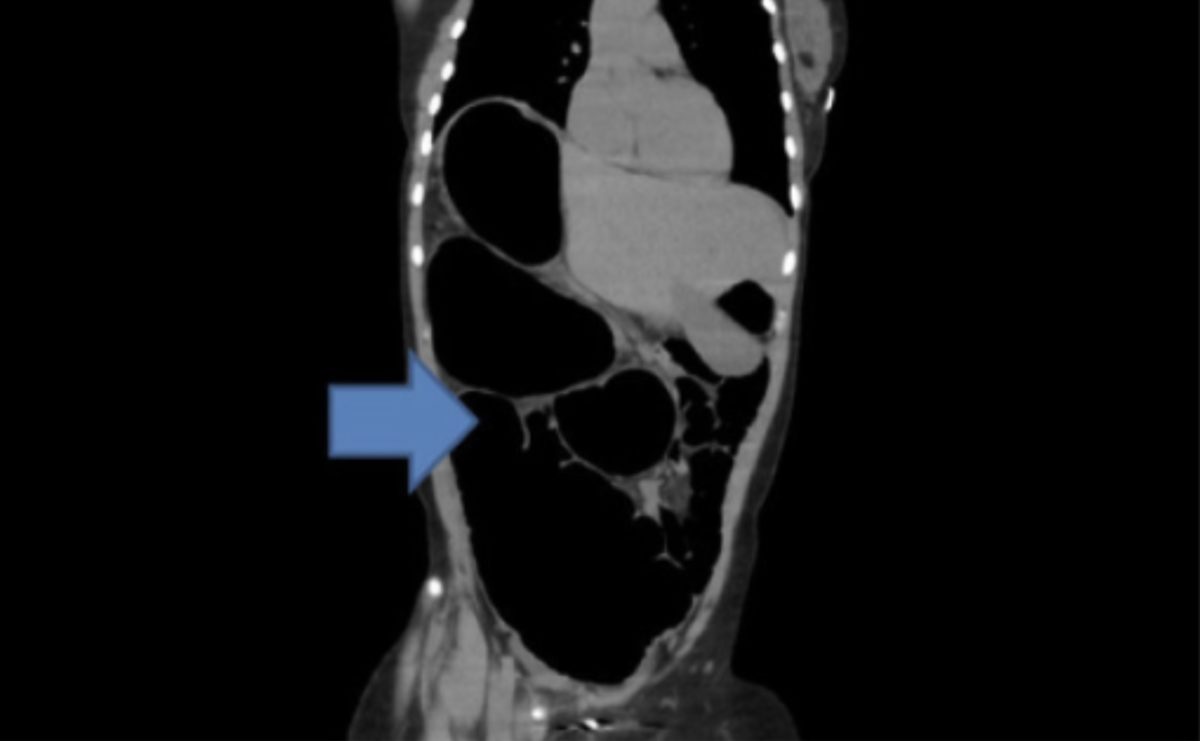 Volvulus na tomografia computadorizada