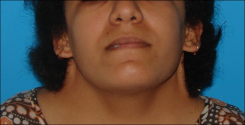 Webbed neck, seen in turner syndrome