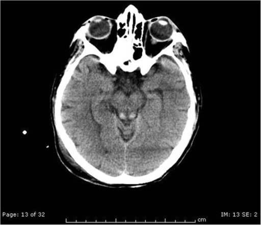 Wernicke's encephalopathy in a malnourished surgical patient