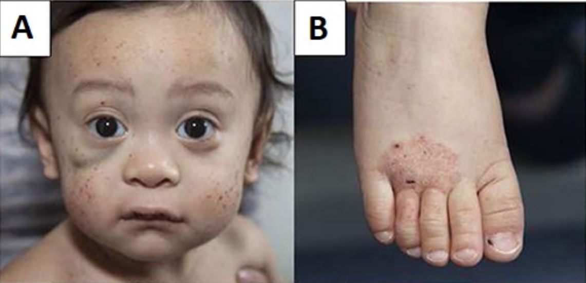Wiskott–Aldrich syndrome presenting with multiple face petechiae