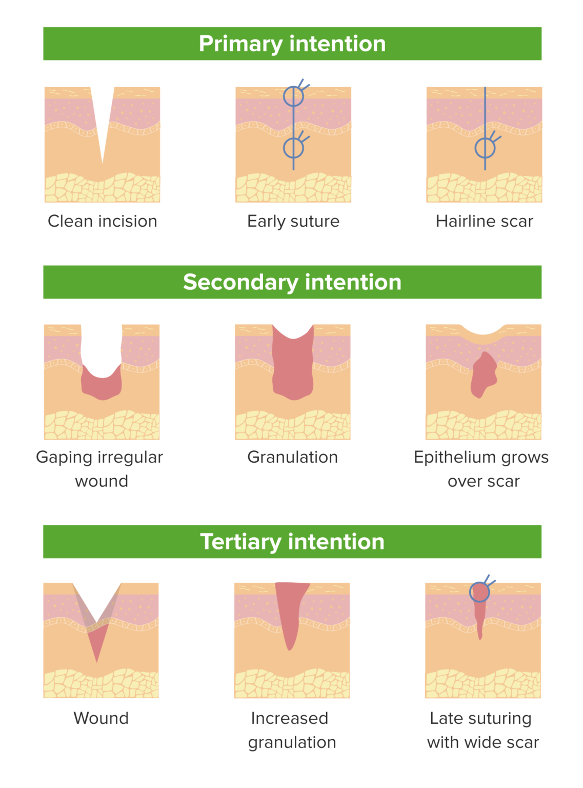 Wound Healing | Concise Medical Knowledge