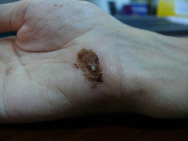 Wound Healing | Concise Medical Knowledge