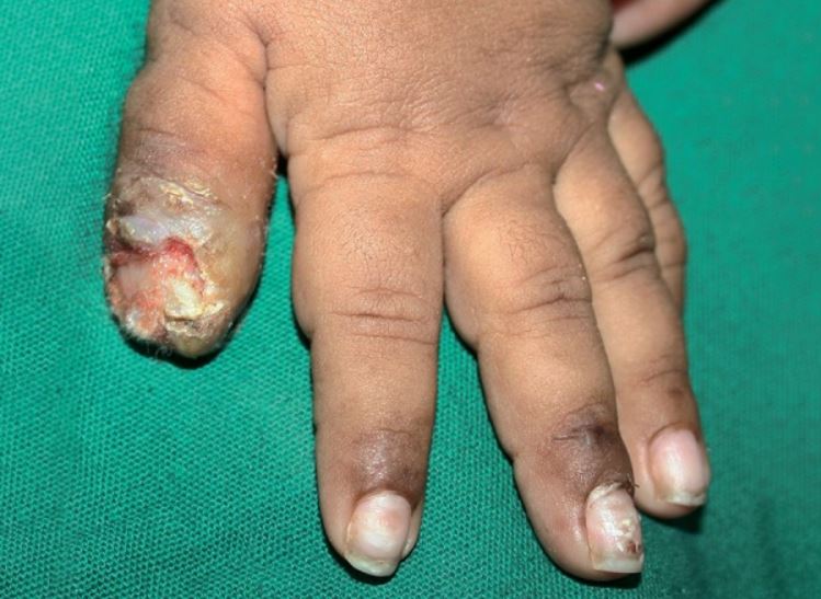 Wounded thumb due to the self mutilation behavior in lesch-nyhan syndrome