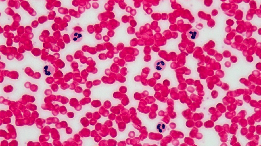 Wright stain of a peripheral blood smear - neutropenia