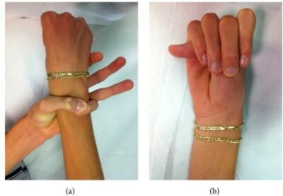 Marfan Syndrome Wrist Sign