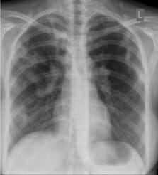X-ray pulmonary tuberculosis