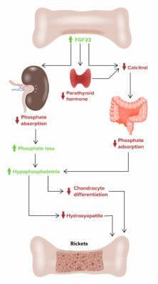 Blood Ph Rickets X-linked Hypophosphatemic Rickets | Concise Medical Knowledge