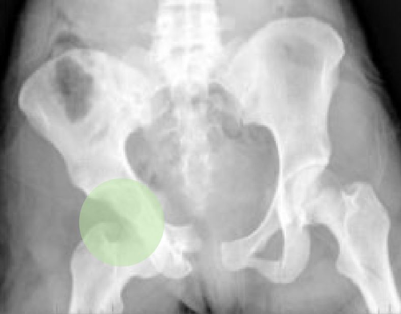 X-ray (ap projection of the pelvis) showing a pelvic fracture