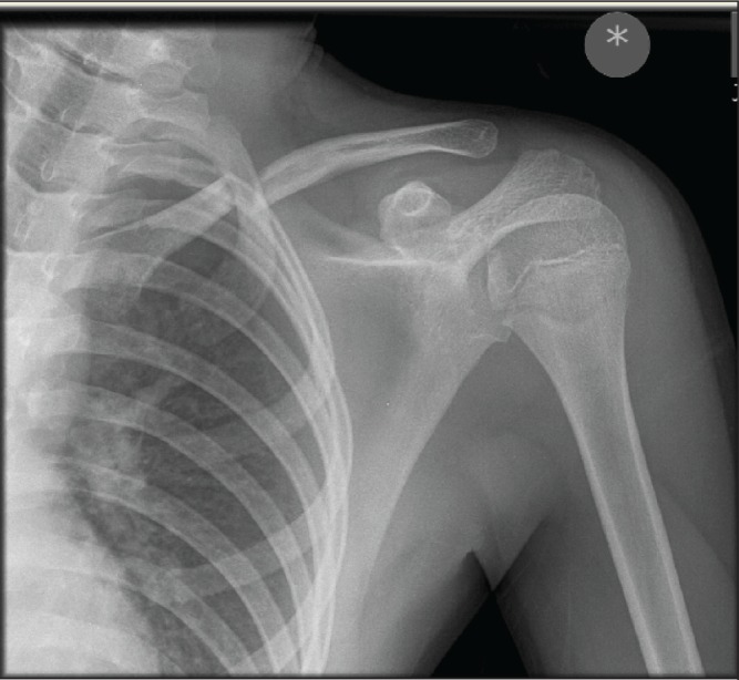 X-ray image of middle third or midshaft fracture of the clavicle