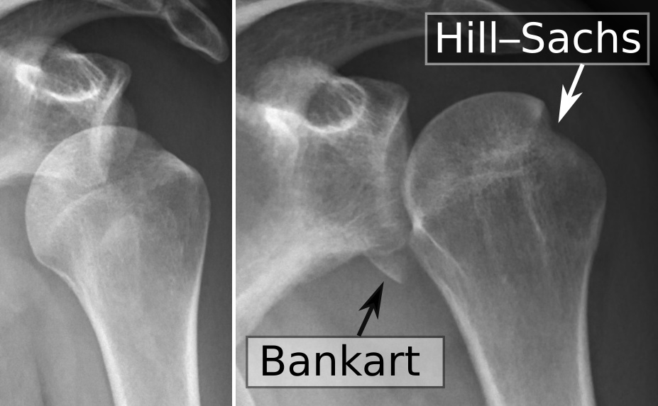 X-ray at left shows anterior dislocation