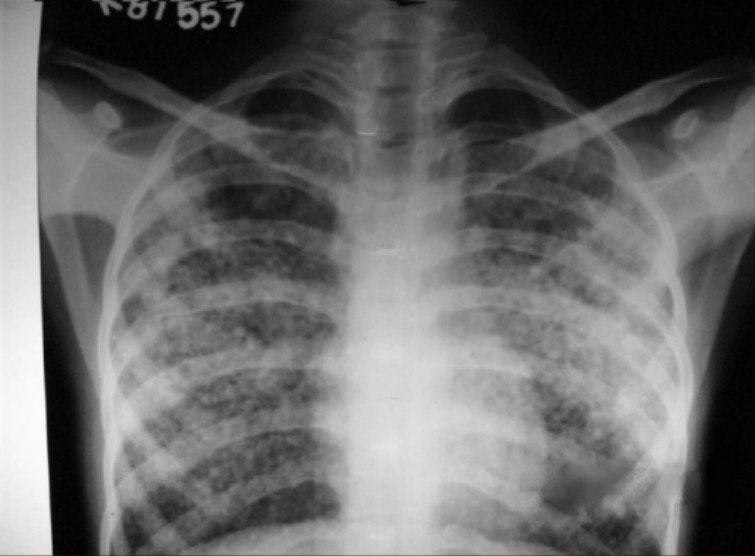 X-ray chest pa view showing pulmonary oedema
