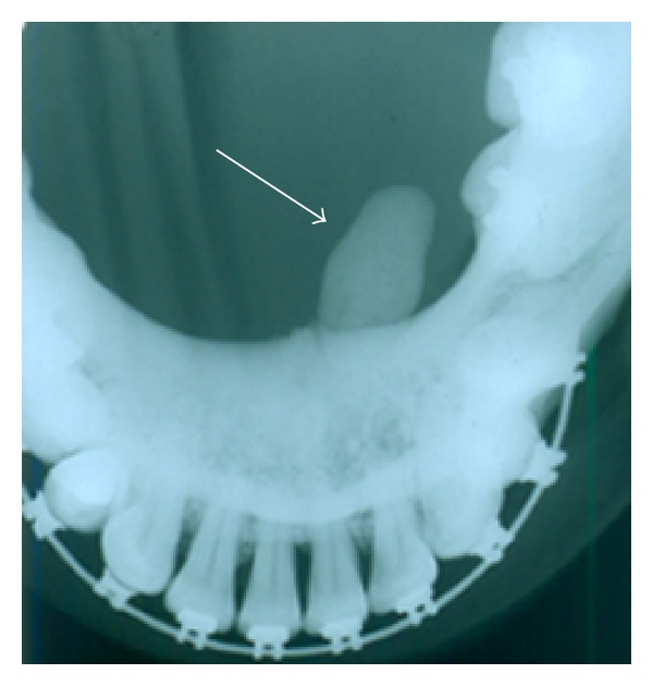 X-ray demonstrating a massive opacity consistent with sialolithiasis