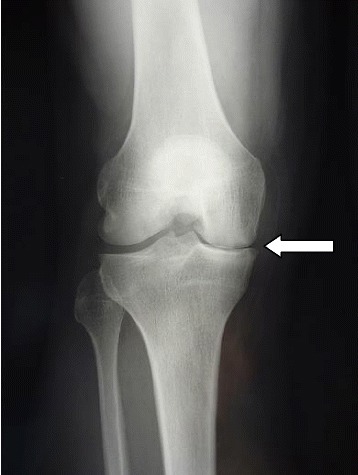 Desgarros de los meniscus (Meniscus Tears) - OrthoInfo - AAOS